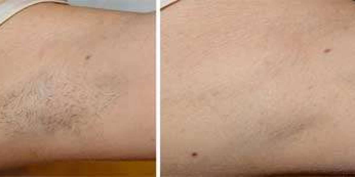 Laser Hair Removal in Houston: Unveiling the Secrets to Silky Smooth Skin: