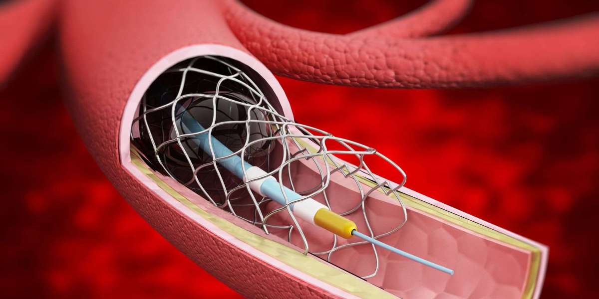 Open Wider, Live Better: Vascular Stents Improve Blood Flow and Reduce Heart Risks