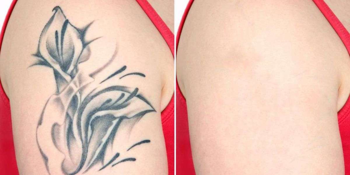 From Black to Bye-Bye: Saying Goodbye to Unwanted Tattoos with Advanced Lasers
