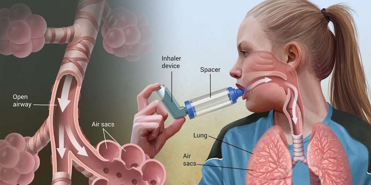 Beyond the Puff: Spacers and Technology Enhance Inhaler Effectiveness