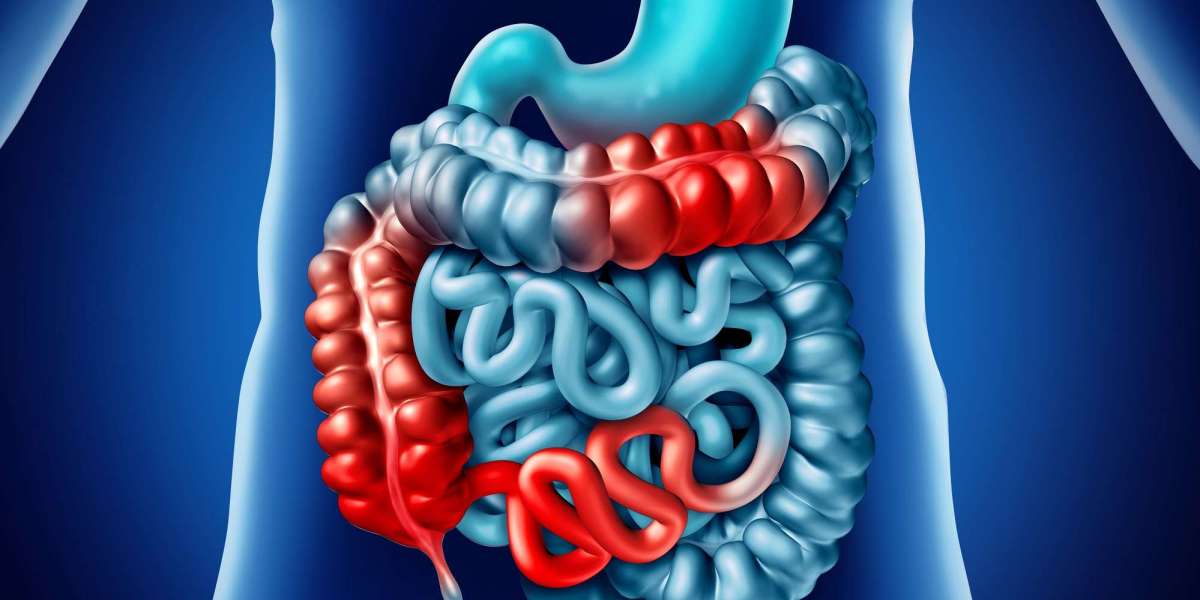 Cost-Effective Bowel Management: Finding the Right Fit