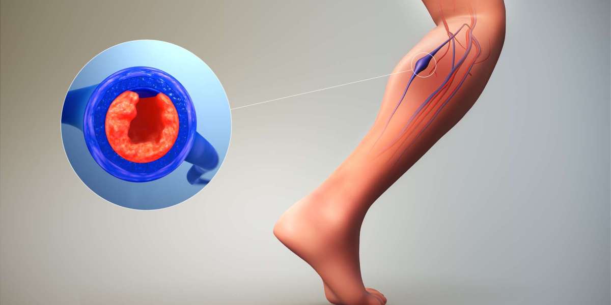 Early Intervention Key to Combating Deep Vein Thrombosis (DVT)