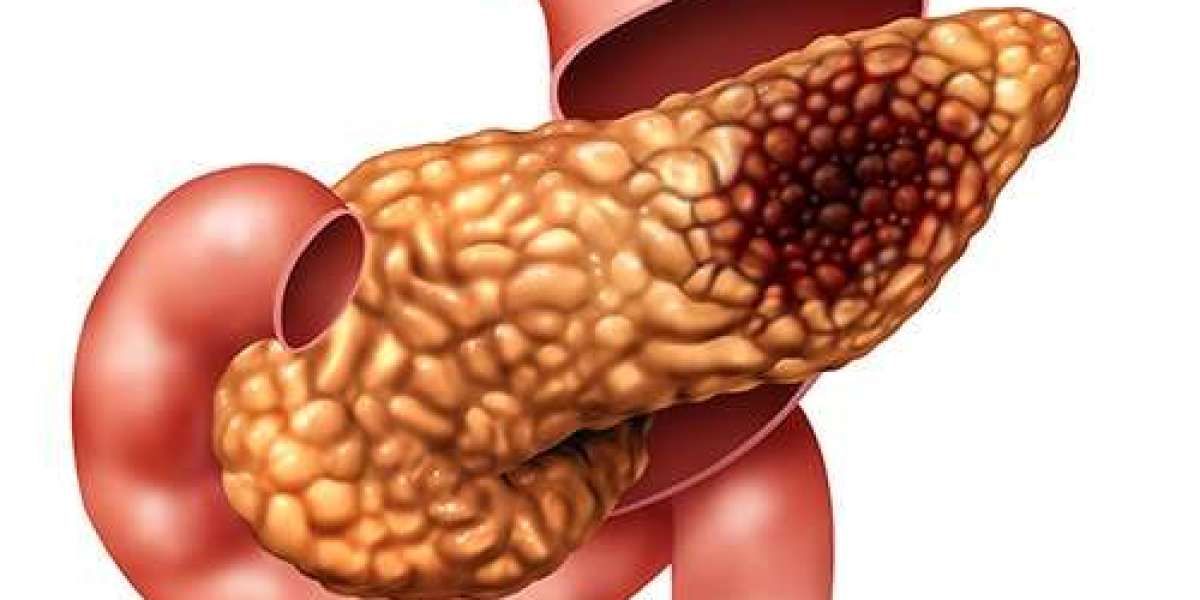 Understanding the Symptoms of Advanced Pancreatic Cancer