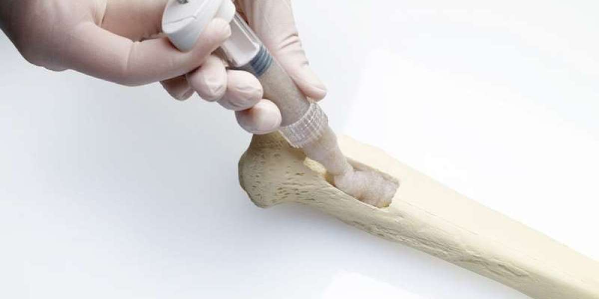Bioactive Bone Graft Substitutes: Revolutionizing Bone Regeneration
