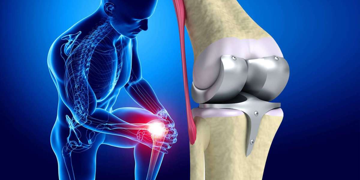 Beyond Pain: The Rise of the Knee Replacement Market and Hope for Active Futures