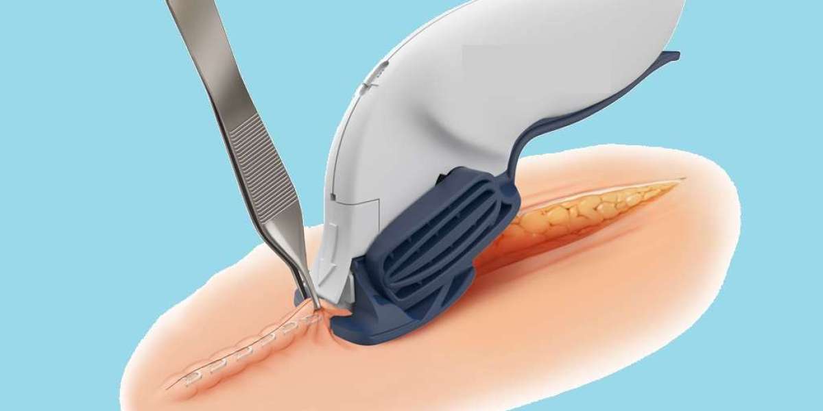 Stapling the Future: Advancements Propel Surgical Stapler Market