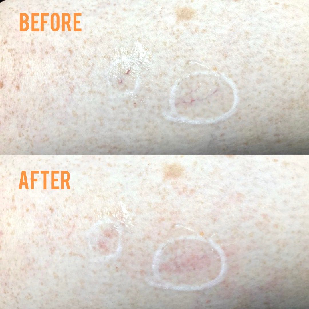 Expert Care for P/V Spot Treatment