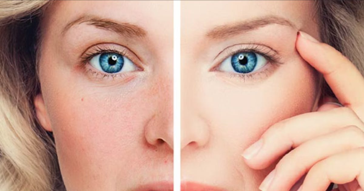 Treat Vascular & Pigmented Lesions – Affordable Solutions You Can Try Today