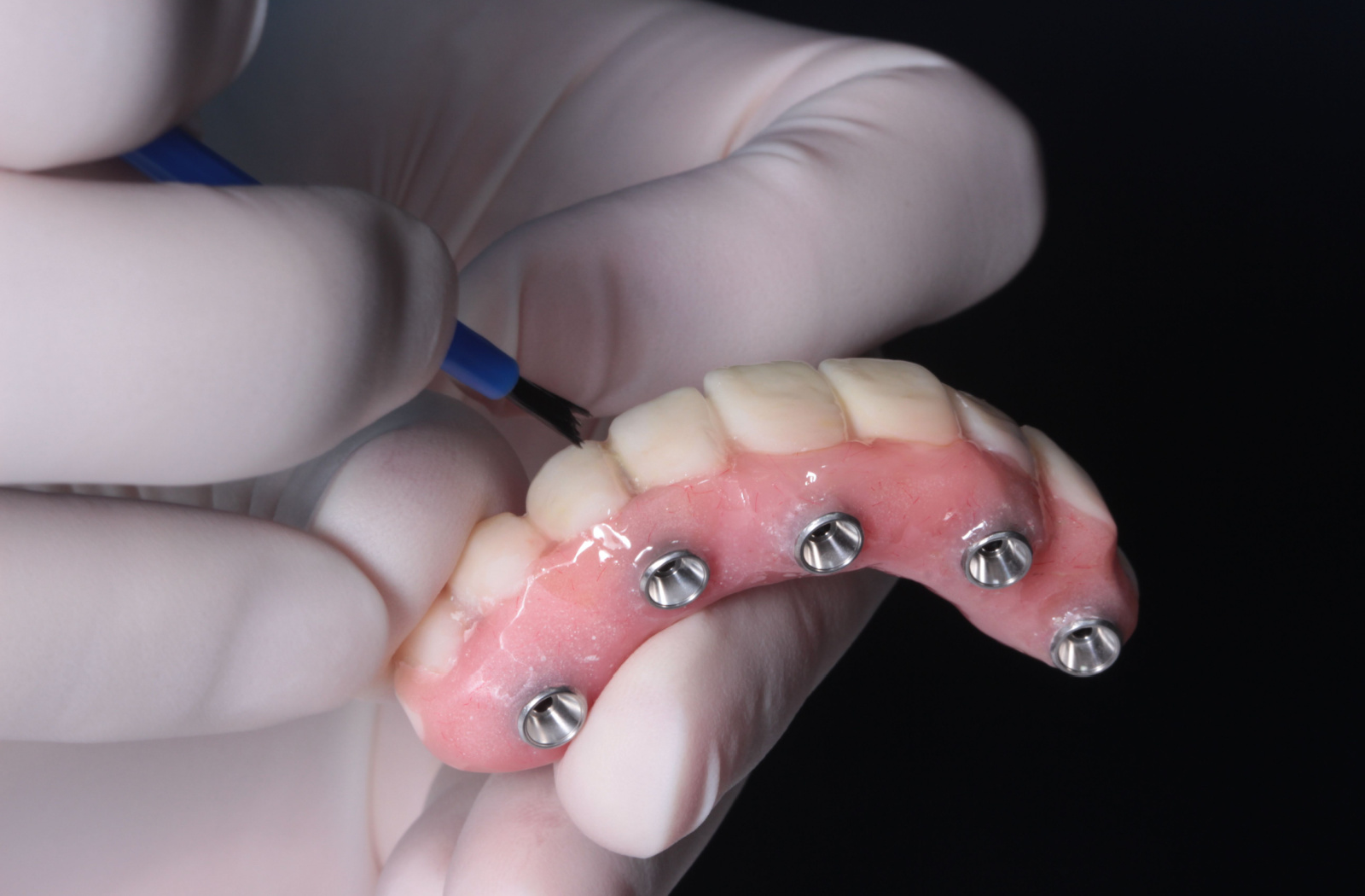 All-on-4 Dental Implants: A Permanent Solution for Missing Teeth – Telegraph