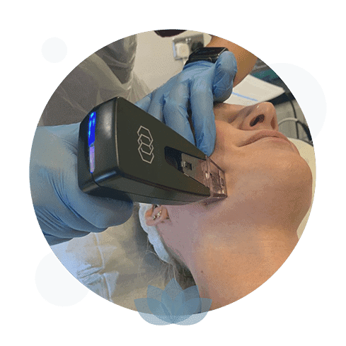 Morpheus8 Treatment: What to Expect and Proper Aftercare Tips