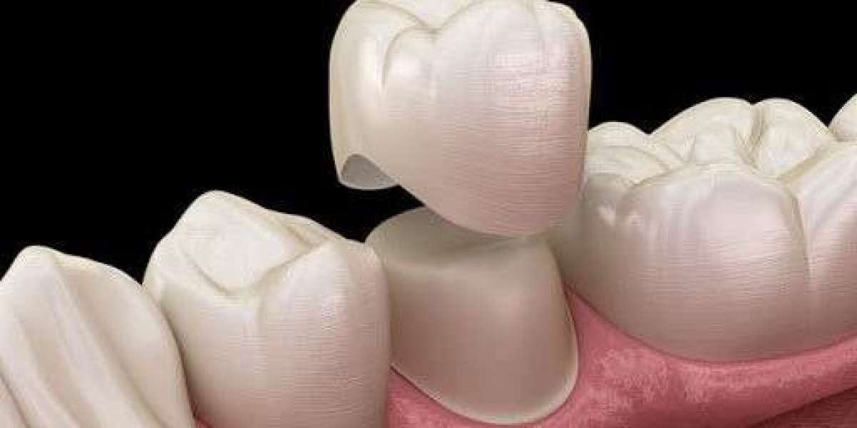 Bọc răng sứ có đau không? Giải đáp toàn diện từ chuyên gia nha khoa