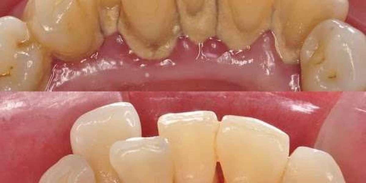 Lấy cao răng: Có nên thực hiện định kỳ? Bao lâu 1 lần? Giá bao nhiêu?