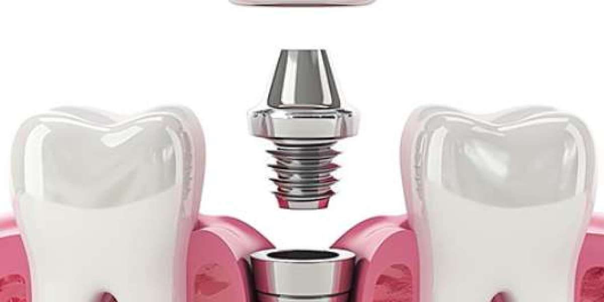 Trồng răng implant ở đâu tốt nhất? Cách chọn đúng địa chỉ phục hình răng hiệu quả và an toàn