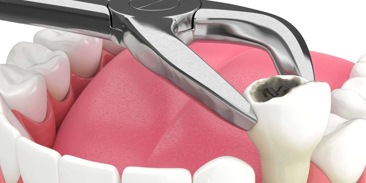 Renewing Your Smile: From Tooth Extraction to All-on-4 Implants in Bakersfield!