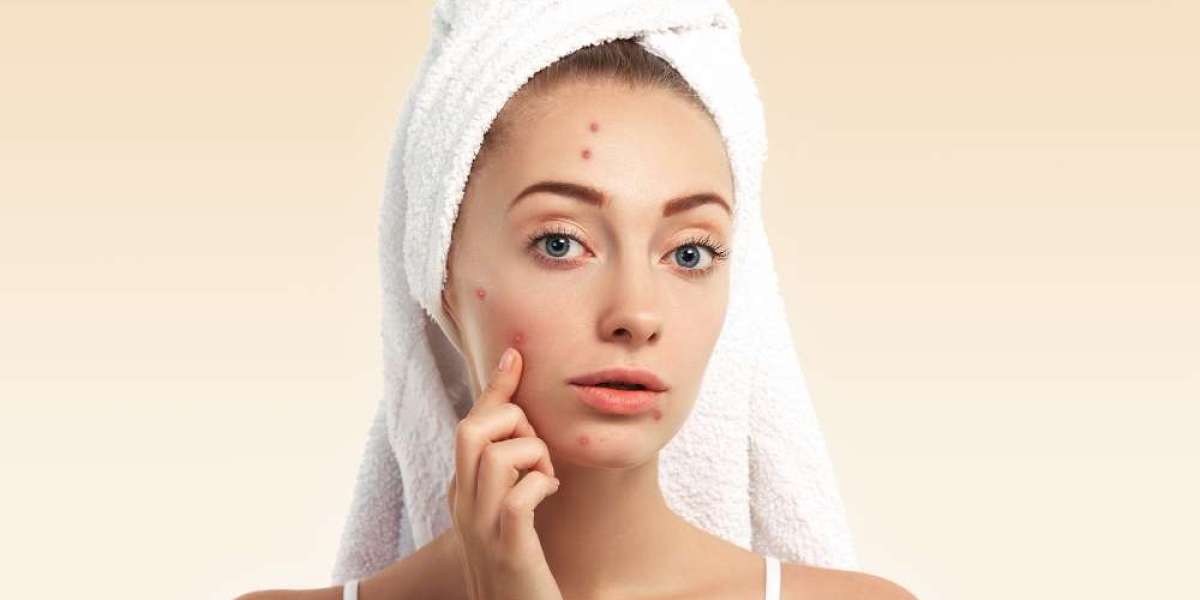 Which Homeopathy Medicines Work Best for Treating Pimples?