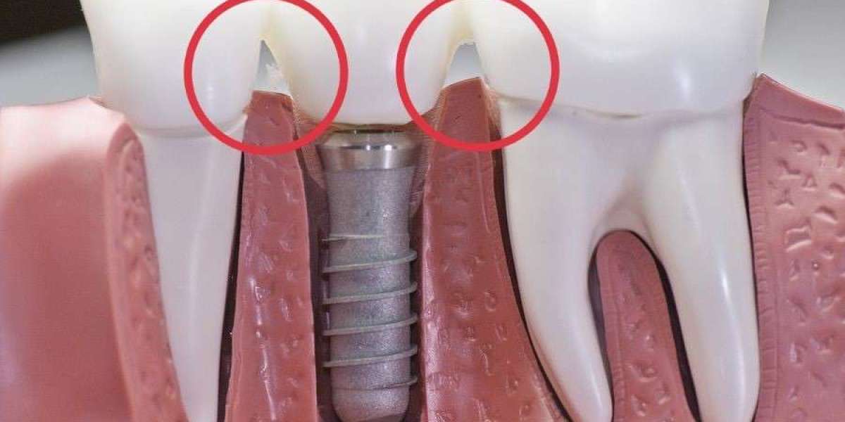 Lưu ý sau khi trồng răng implant: Hướng dẫn chi tiết giúp phục hồi nhanh và an toàn