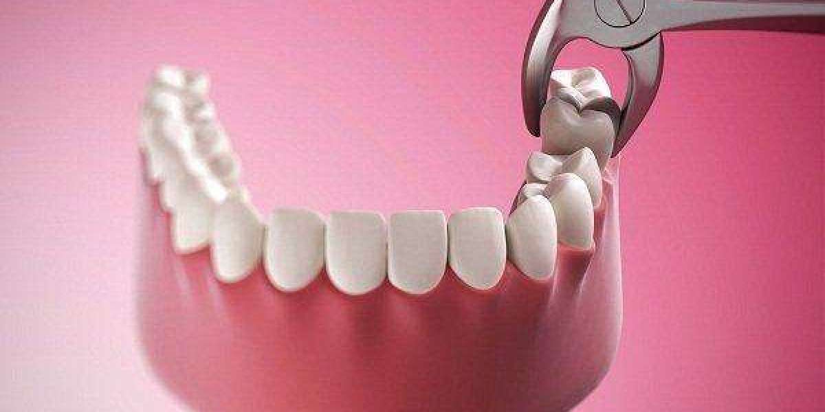 Nhổ răng khôn hàm dưới: Có đau không? Bao lâu lành? Bao nhiêu tiền?