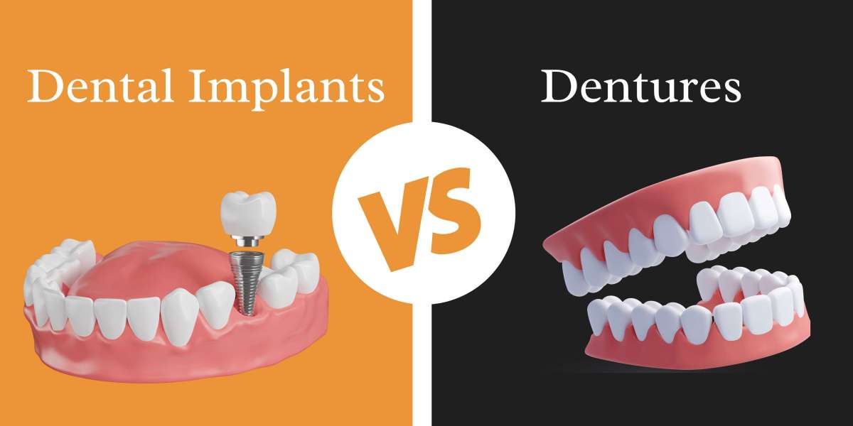 Dental Implants vs. Dentures: What Patients Should Know