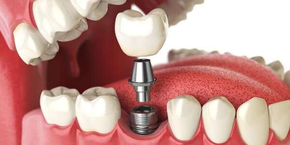 Trồng răng implant tại Hà Nội: Giải pháp phục hình răng mất an toàn, tiết kiệm và hiệu quả lâu dài