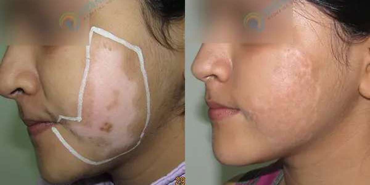 Vitiligo: Types, Symptoms, and Effective Treatment Options