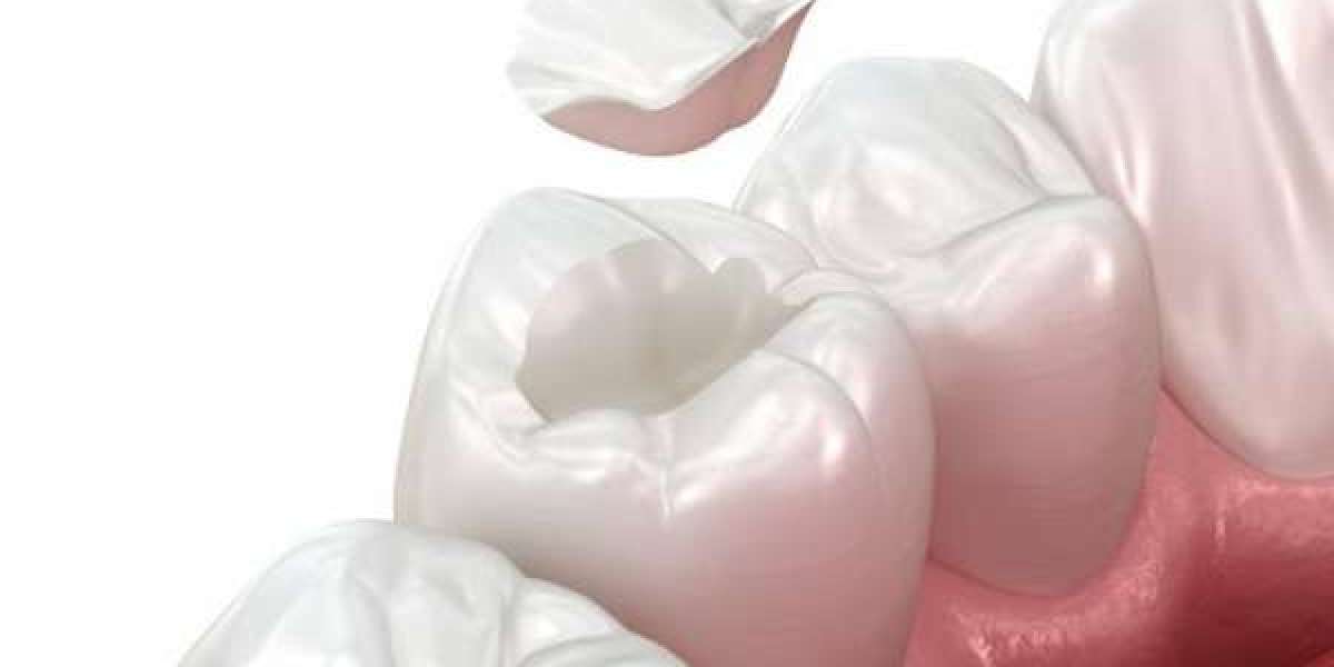 Giá trám răng sâu: Những yếu tố ảnh hưởng và bảng giá chi tiết