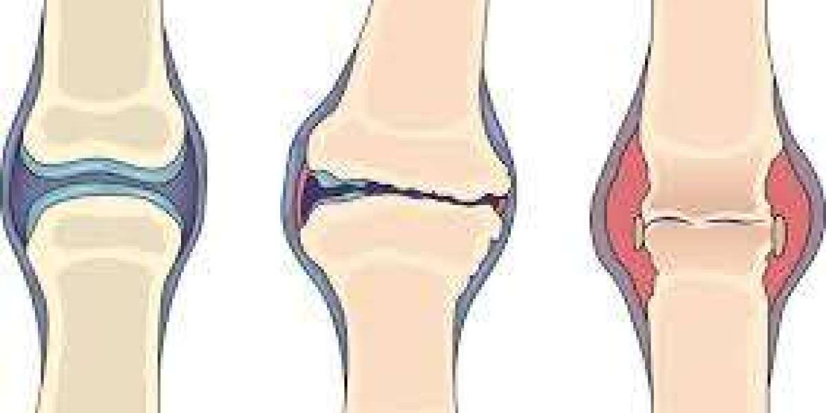 Osteoarthritis or Rheumatoid Arthritis? Understanding the Difference