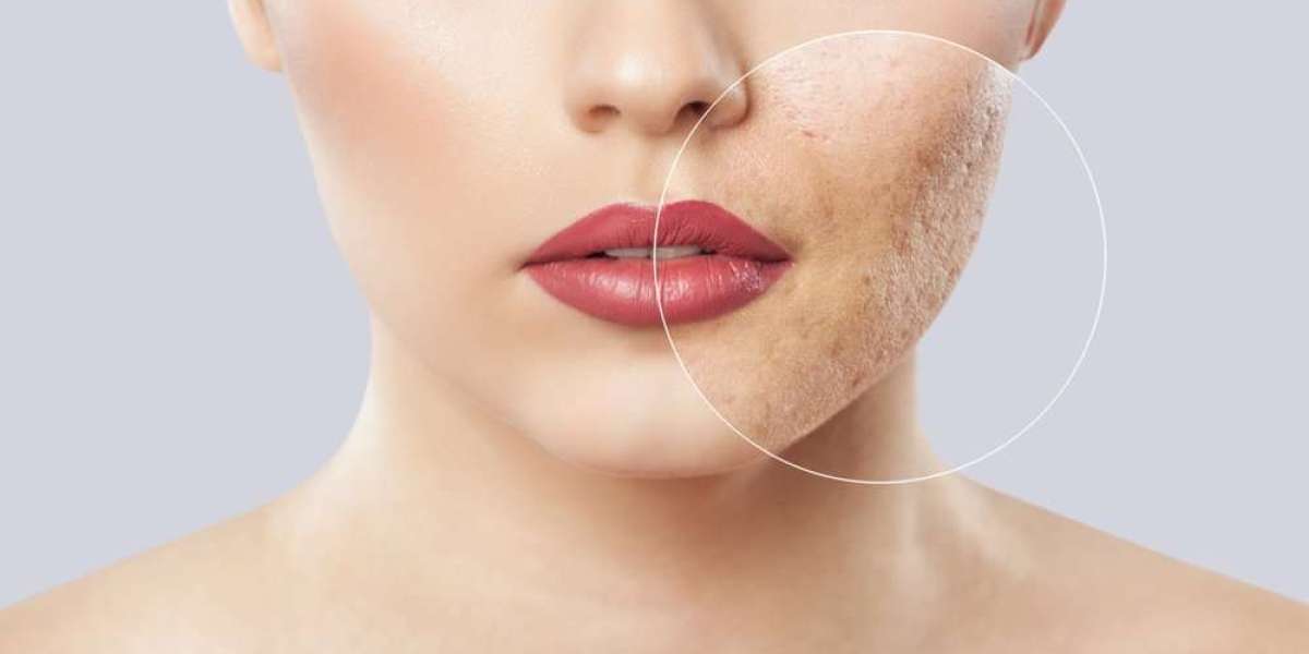 Why Acne Scars Happen and How to Treat Them in Islamabad