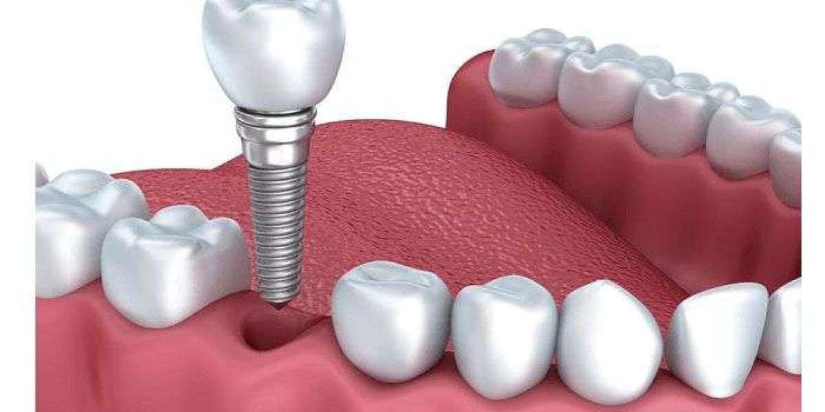 Trồng răng giả implant: Giải pháp phục hình răng mất hiện đại và bền vững