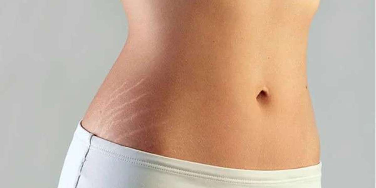 Stretch Marks: Treatment Options, Benefits and Risks