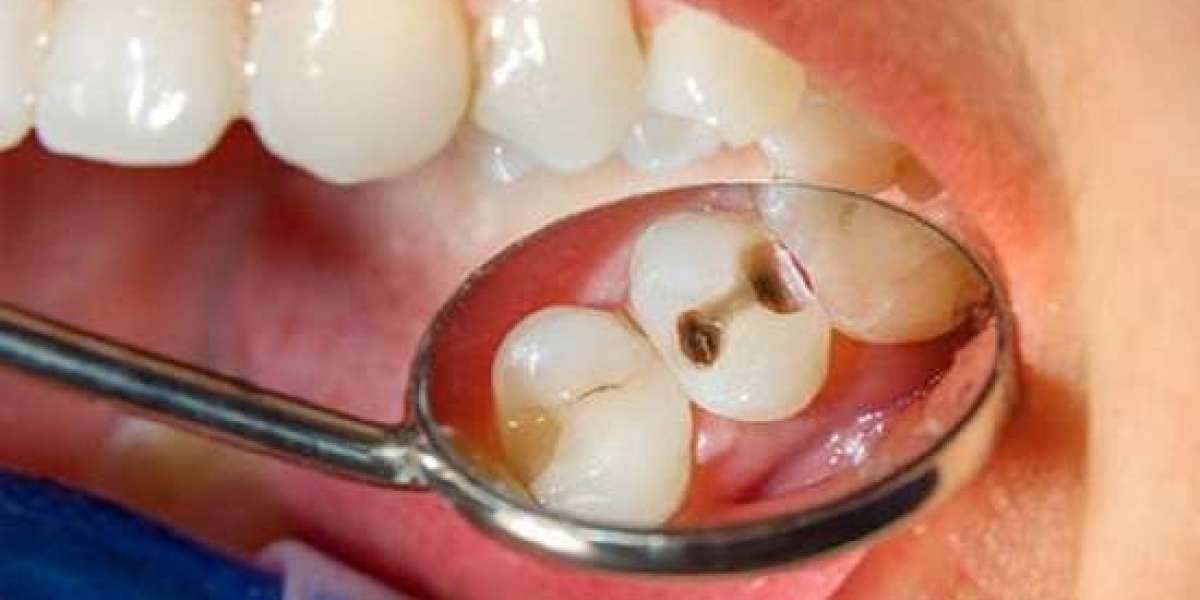 Trám răng không lấy tủy có sao không? Giải đáp từ chuyên gia phục hình