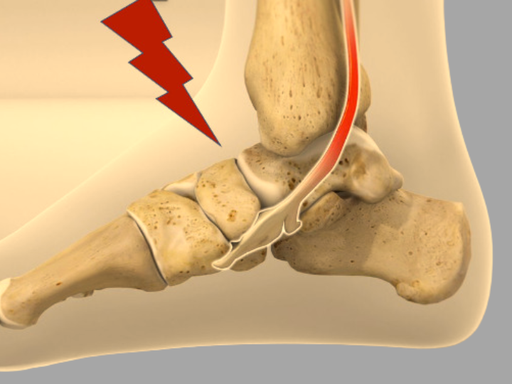 anterior ankle impingement- Foot & Ankle Center of Arizona