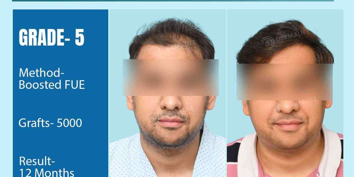 Who is The Best Celebrity Hair Transplant Doctor in Delhi?