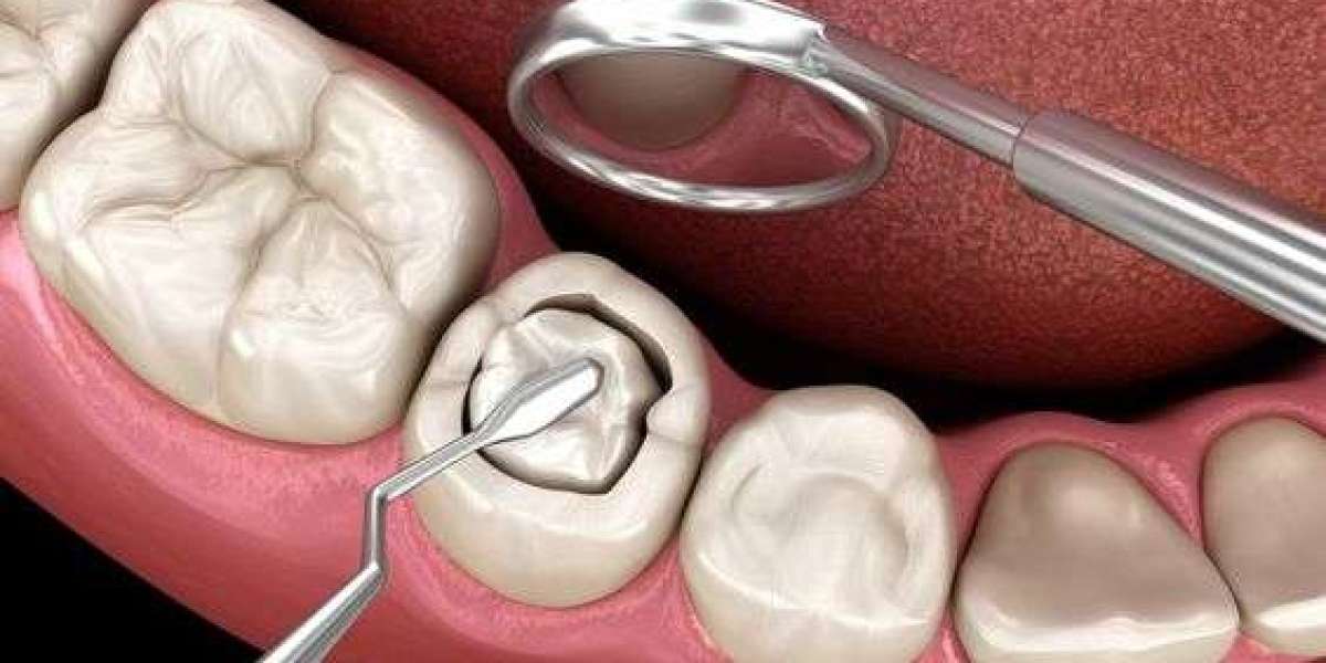 Trám răng đau không? Cảm giác thật sự và cách kiểm soát hiệu quả