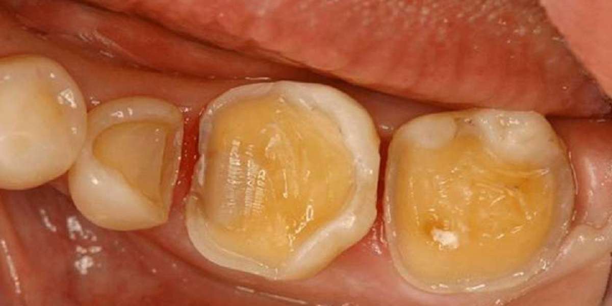 Răng sâu bị vỡ có trám được không? Hướng phục hồi phù hợp cho từng tình trạng