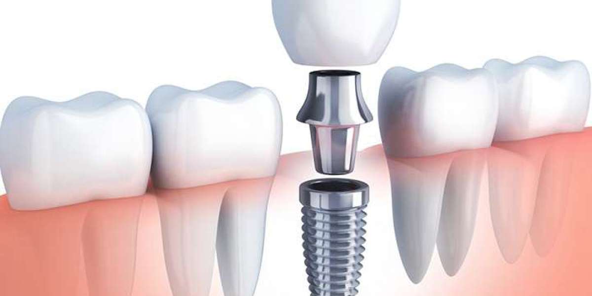Trồng răng implant đau không? Sự thật bạn cần biết trước khi quyết định điều trị