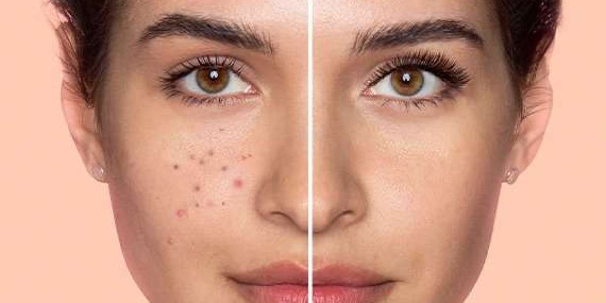 Rejuvenate Your Skin with RF Microneedling in Royal Palm Beach