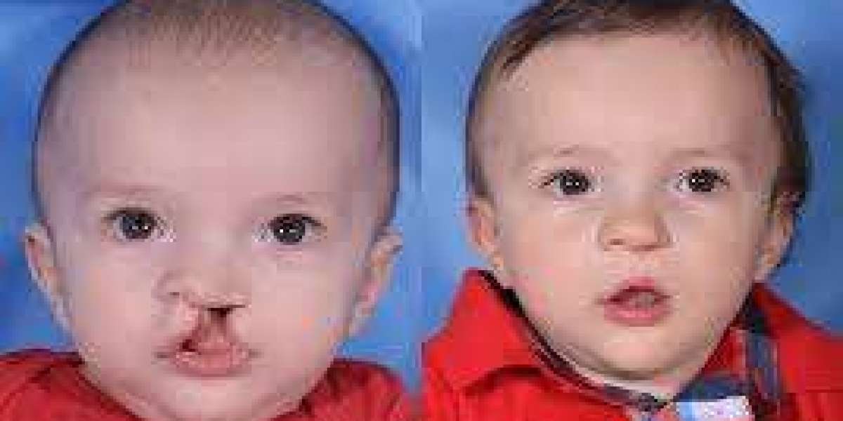 Transforming Smiles: Cleft Lip and Palate Treatment in Islamabad
