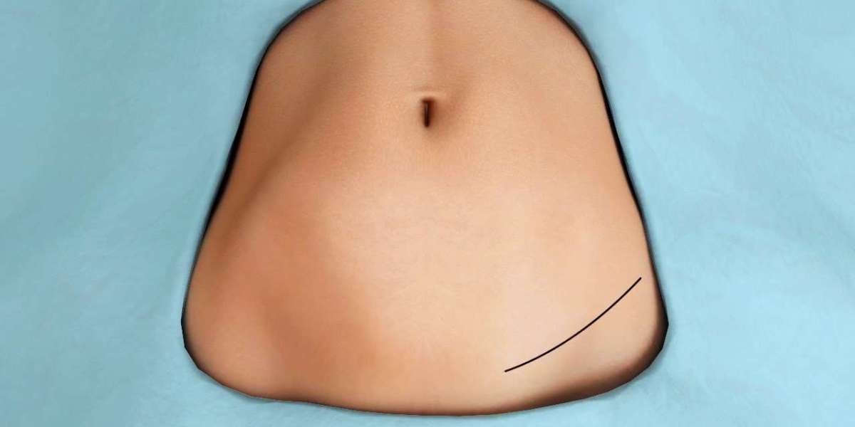 Tubeless Tummy Tuck NYC – No Drain, No Hassle