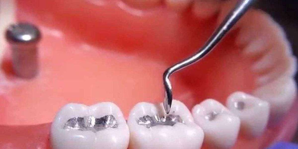 Răng bị sâu lỗ to có trám được không? Giải đáp từ chuyên gia