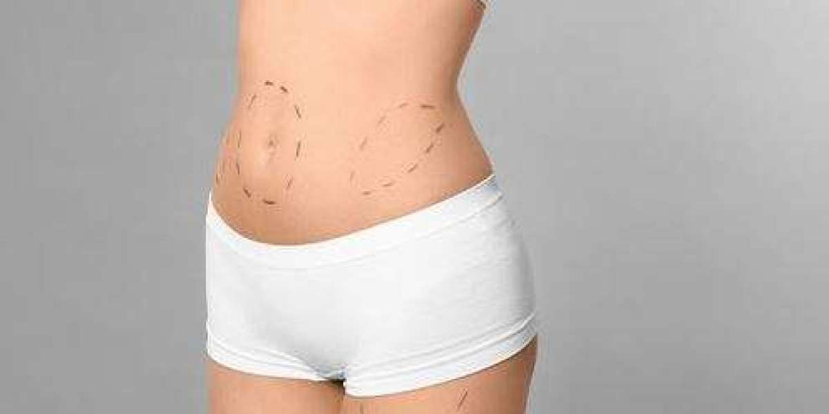 Liposuction: Everything You Need to Know in 2025