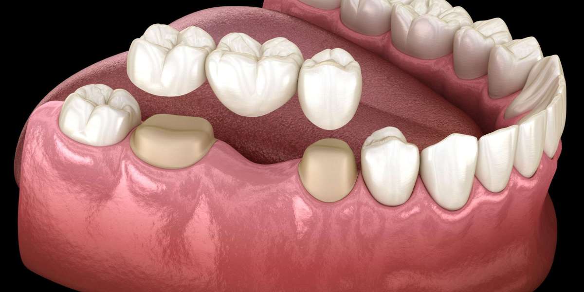 Natural-Looking Crowns for Lasting Smile Makeovers
