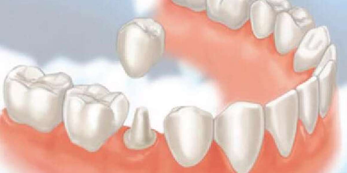 Bọc răng sứ không mài: Xu hướng mới trong thẩm mỹ răng hiện đại