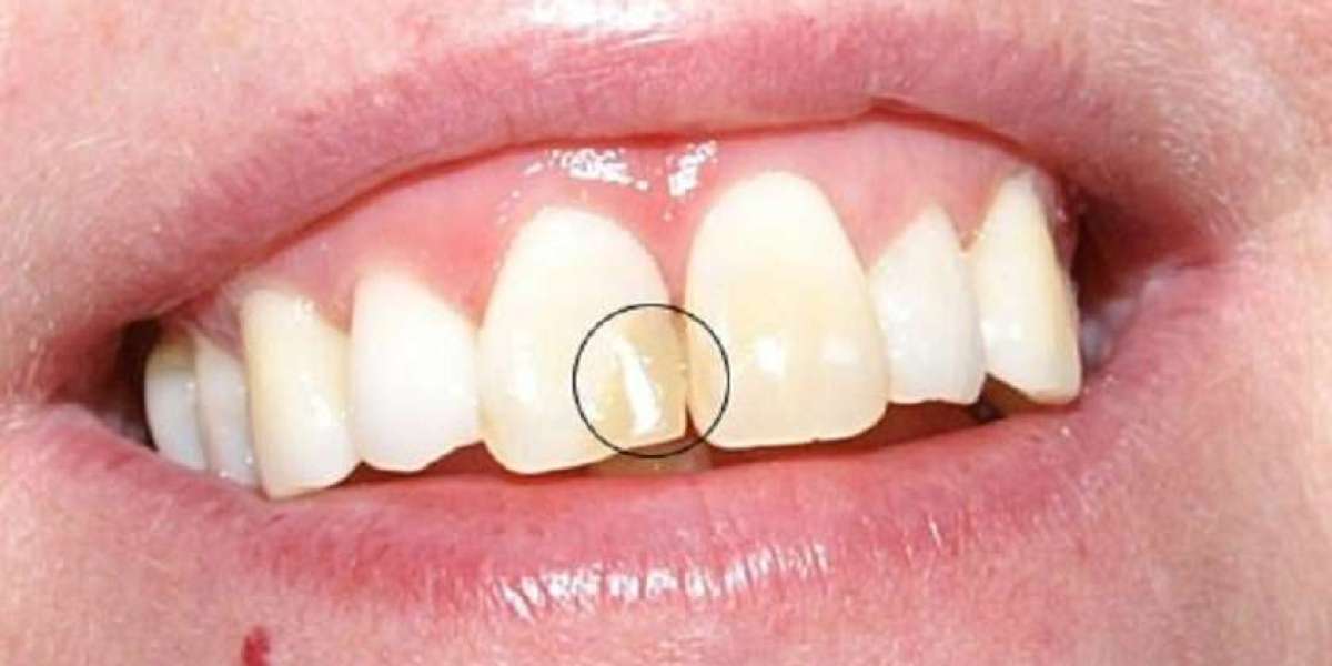 Răng cửa bị mẻ có trám được không? Giải pháp phục hồi an toàn và thẩm mỹ