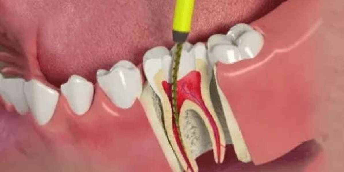Trám răng không lấy tủy có sao không? Giải đáp từ chuyên gia phục hình