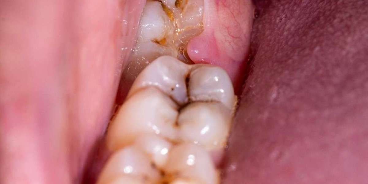 Nha khoa nhổ răng khôn – Giải pháp không còn là nỗi sợ