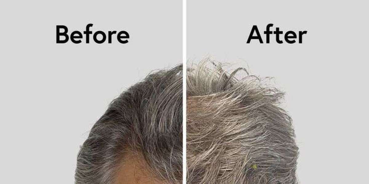 Is Hair Transplant Permanent? Find Out in Islamabad