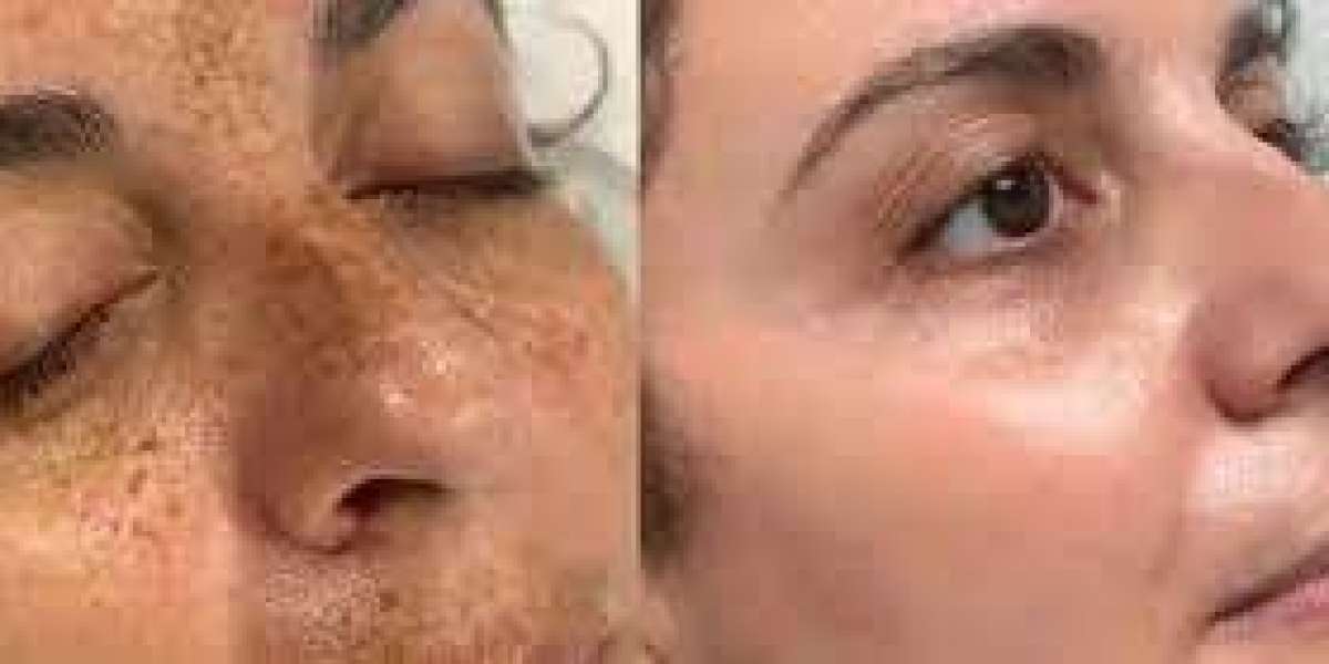Pico Laser Treatment in Islamabad: The Smart Choice for Flawless Skin