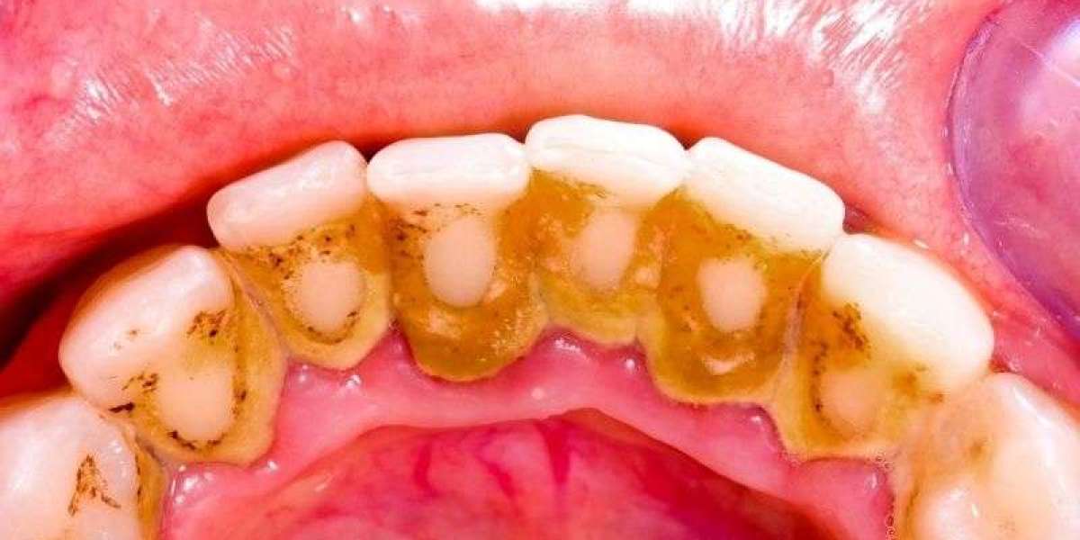 Trám răng là gì? Hiểu đúng về thủ thuật nha khoa phổ biến ai cũng nên biết