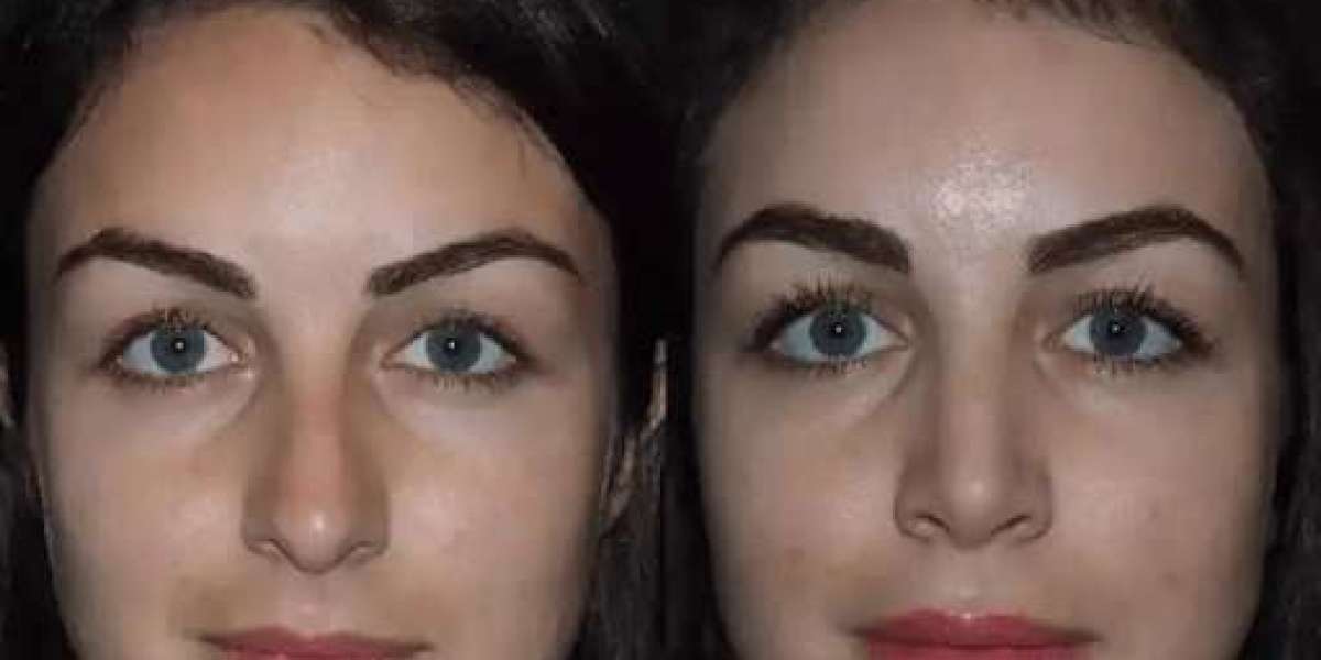 Nose Surgery in Dubai: Combining Art with Precision