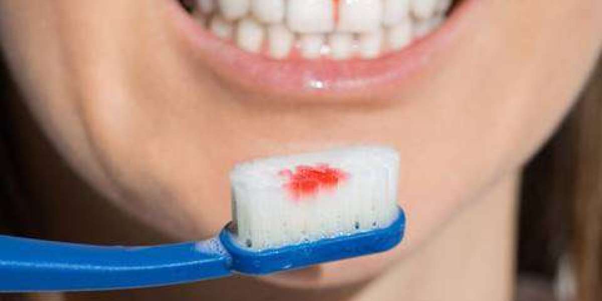 Gum Disease Treatment in San Antonio, TX – Restore Your Oral Health with Primo Dental